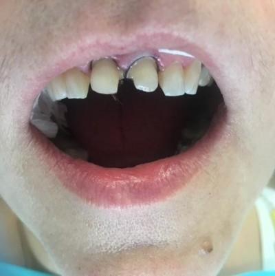 zęby przez zabiegiem